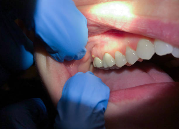 Best Emergency Dental Care for Broken or Chipped Teeth in Pea Ridge, FL